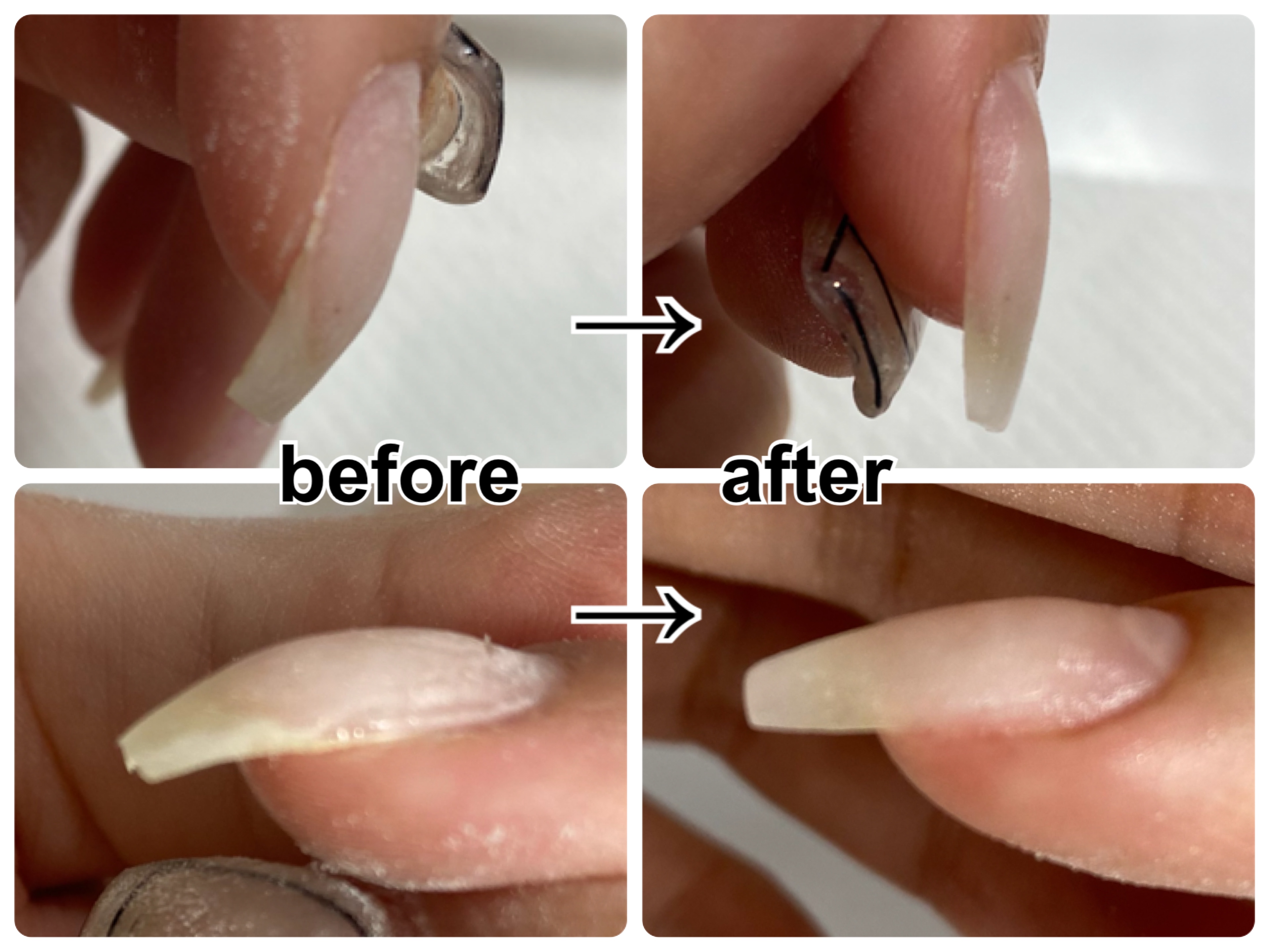 切らず、短時間、簡単！【鷲爪巻き爪矯正】のやり方